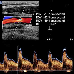 Ecocolor doppler