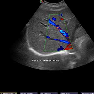 Ecografia EPATICA