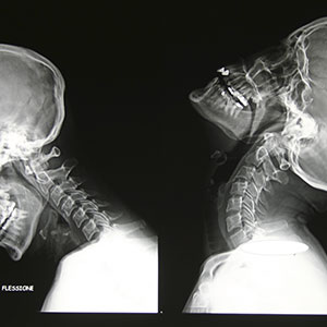 Foto di una risonanza magnetica rachide cervicale